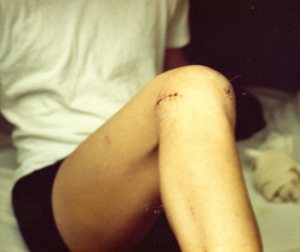 January 1978: Today the "scars" would be  the size of pin pricks. 